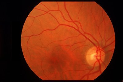 Retinografía ojo derecho