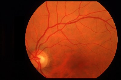 Retinografía ojo izquierdo